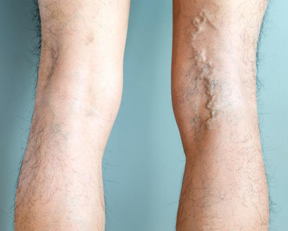 Varicose Vein Treatments