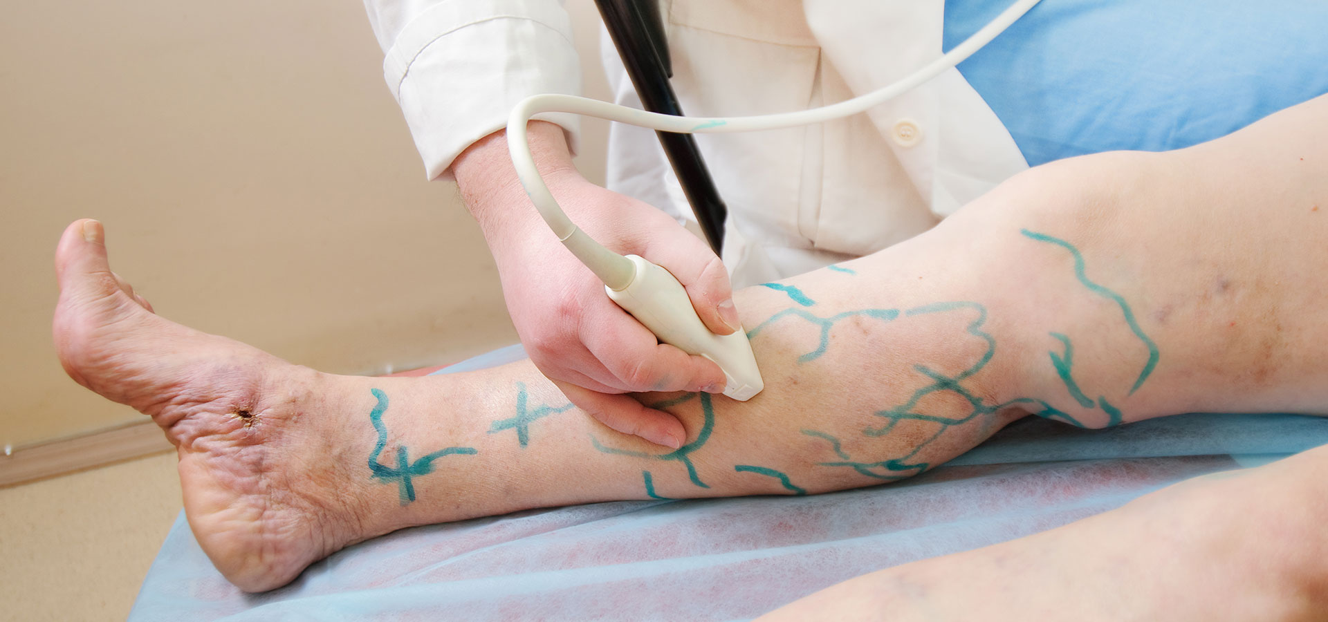 Varicose Vein Treatments